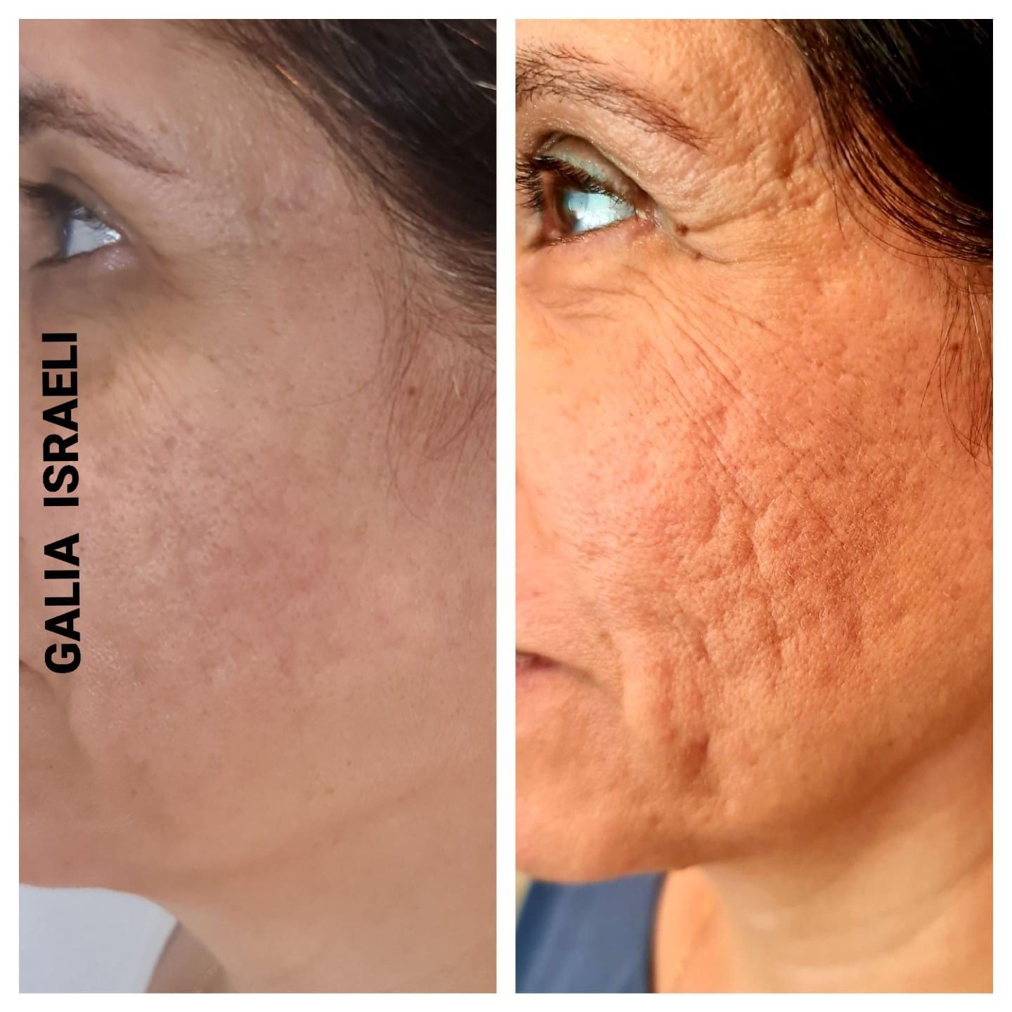 Before and after — Cheek Firmness Support