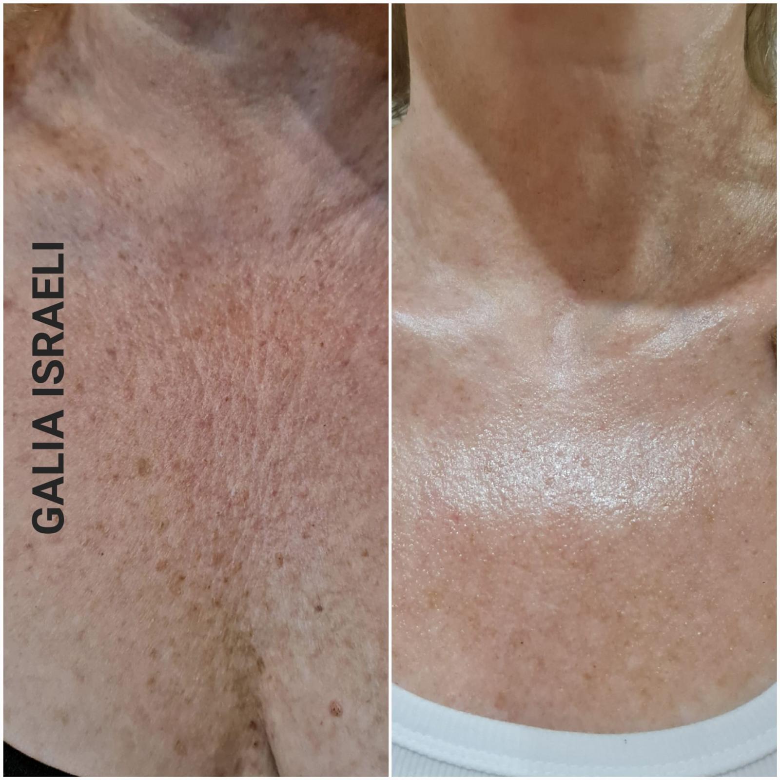 Before and after — Décolleté Pigmentation