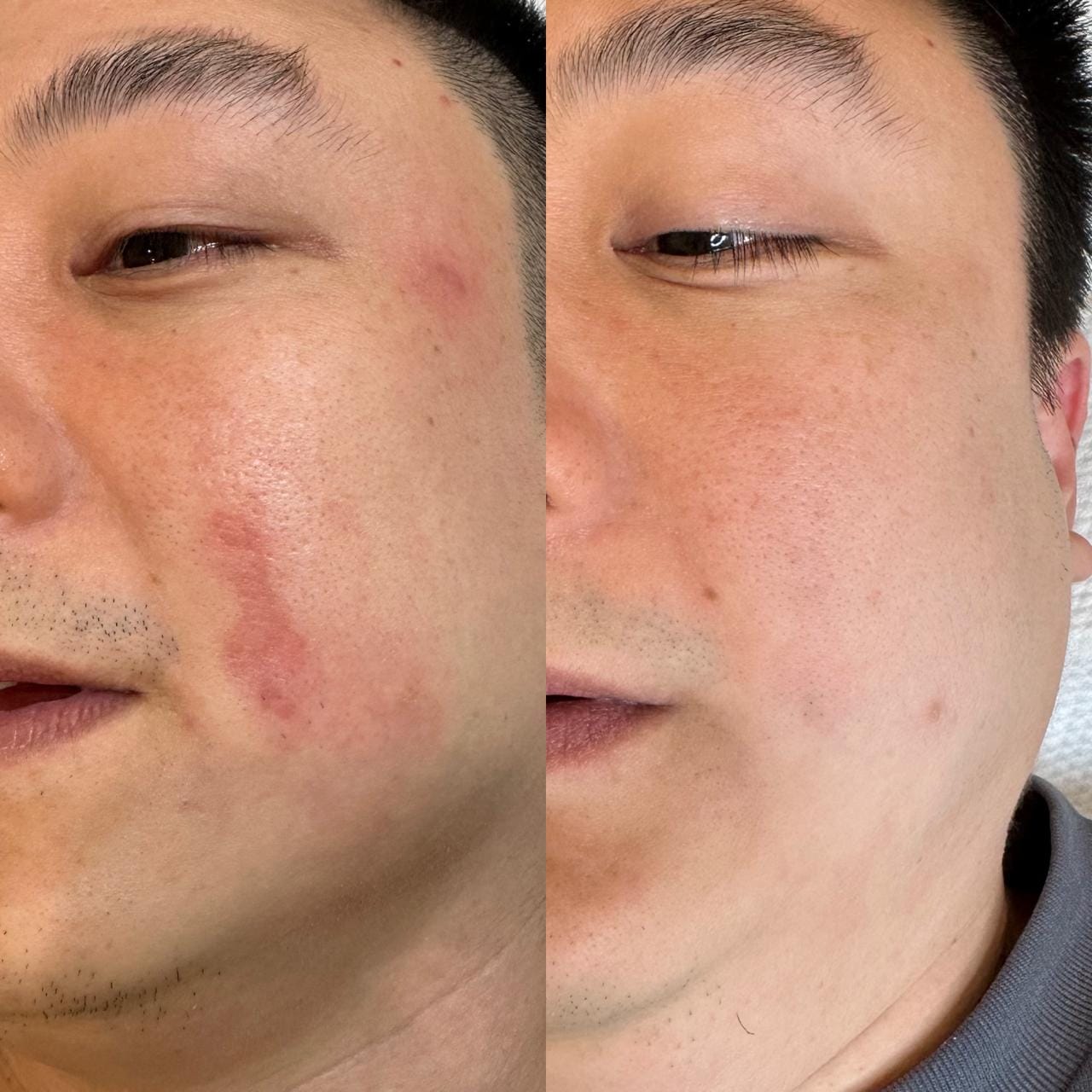 Before and after — Facial Redness & Marks