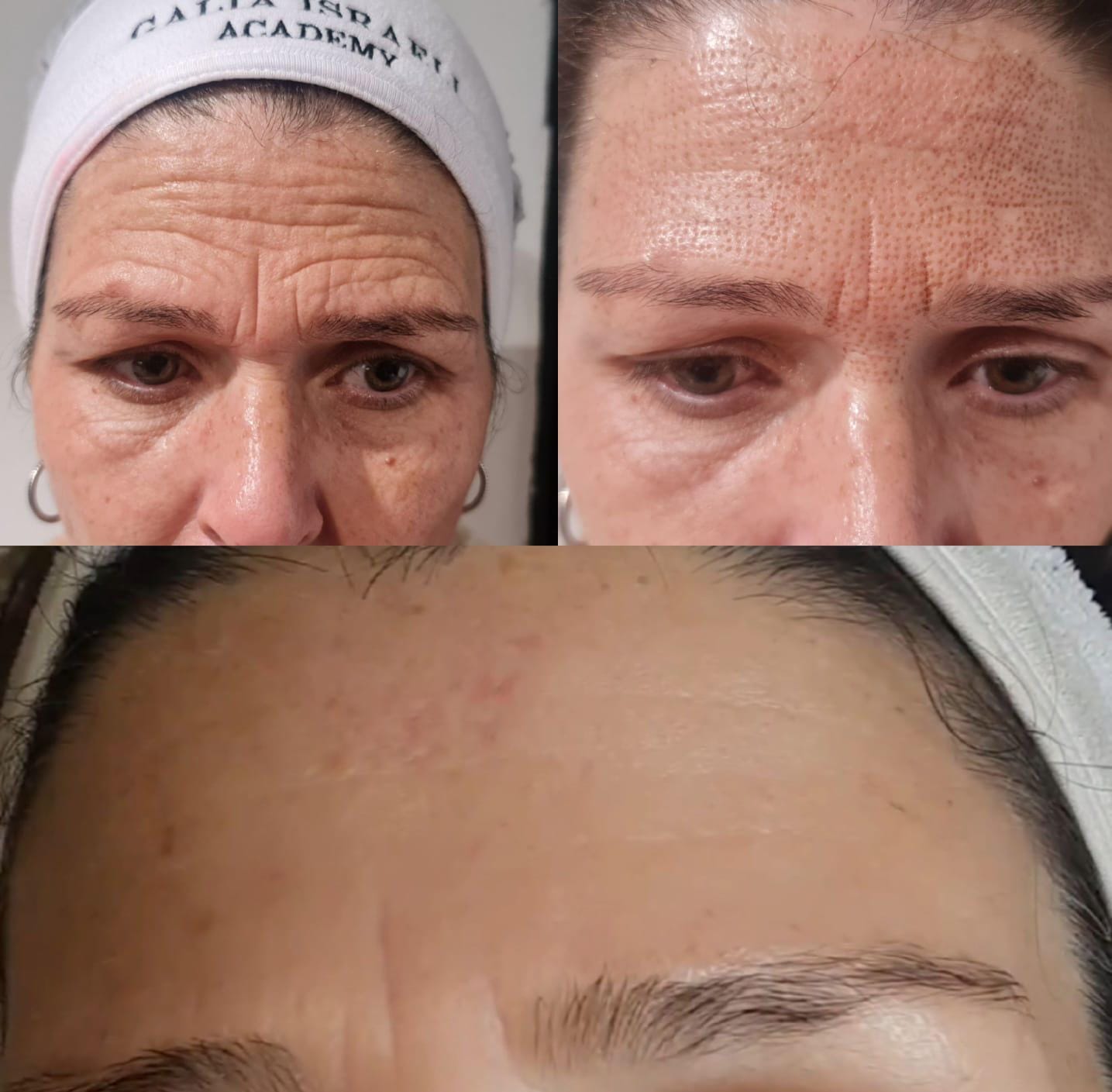 Before and after — Forehead Line Softening
