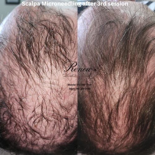Before and after — Follicular Density Increase