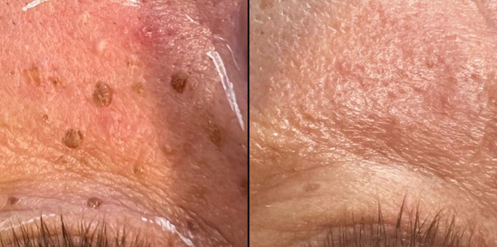 Before and after — Lesion Removal