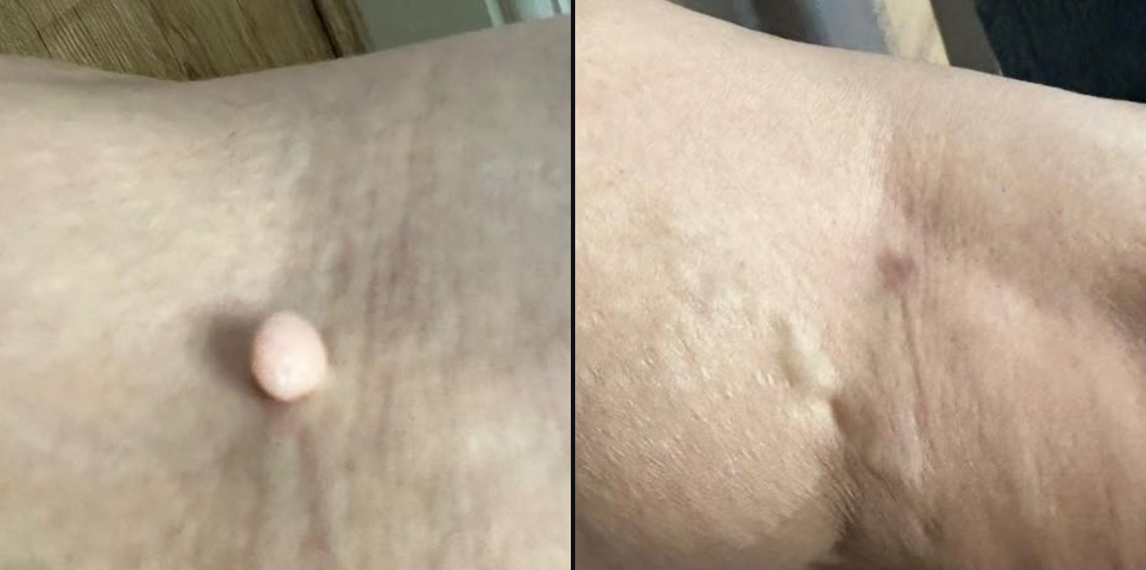 Before and after — Lesion Removal