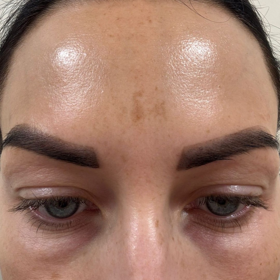 Before and after — Pigmentation Appearance