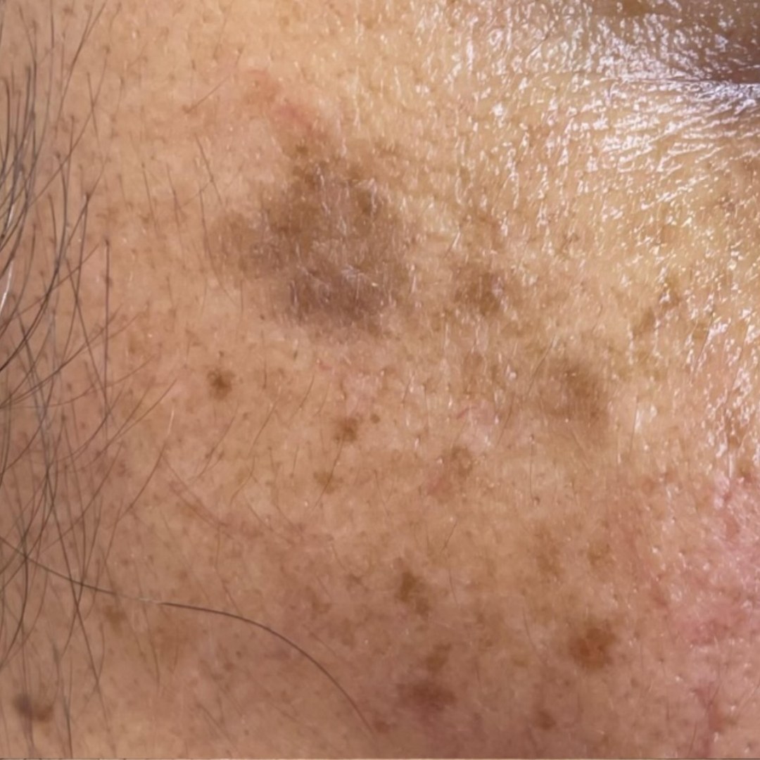 Before and after — Pigmentation Appearance