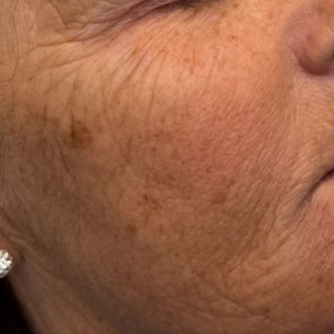 Before and after — Pigmentation Appearance