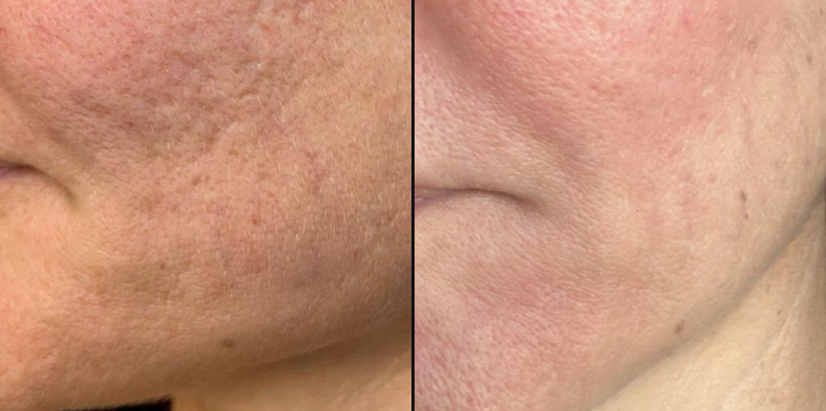 Before and after — Scar Revision