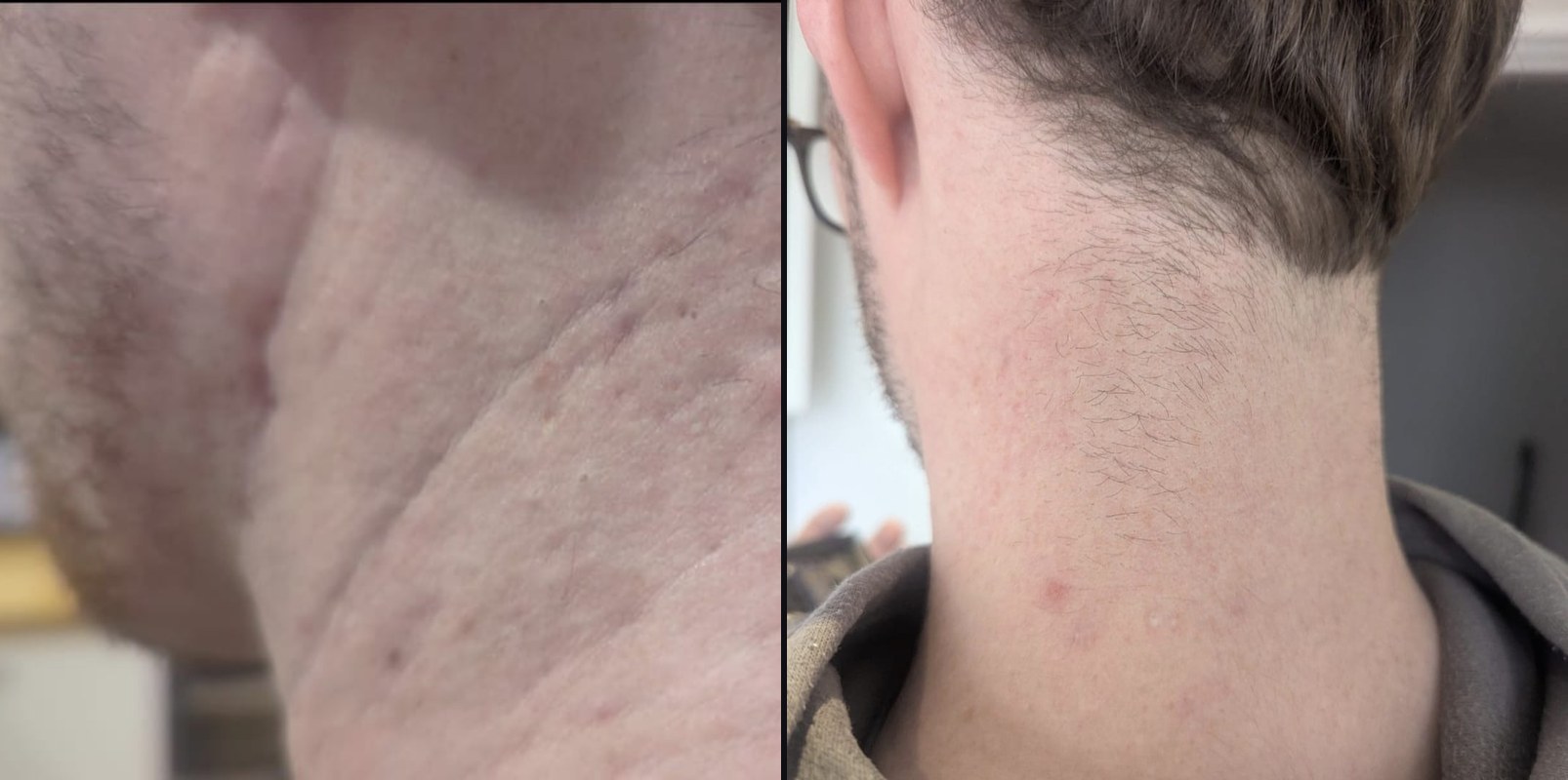Before and after — Scar Revision