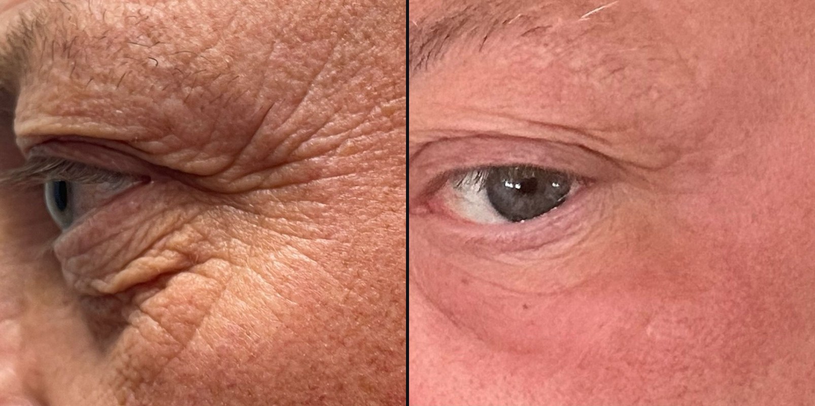 Before and after — Skin Lifting & Tightening