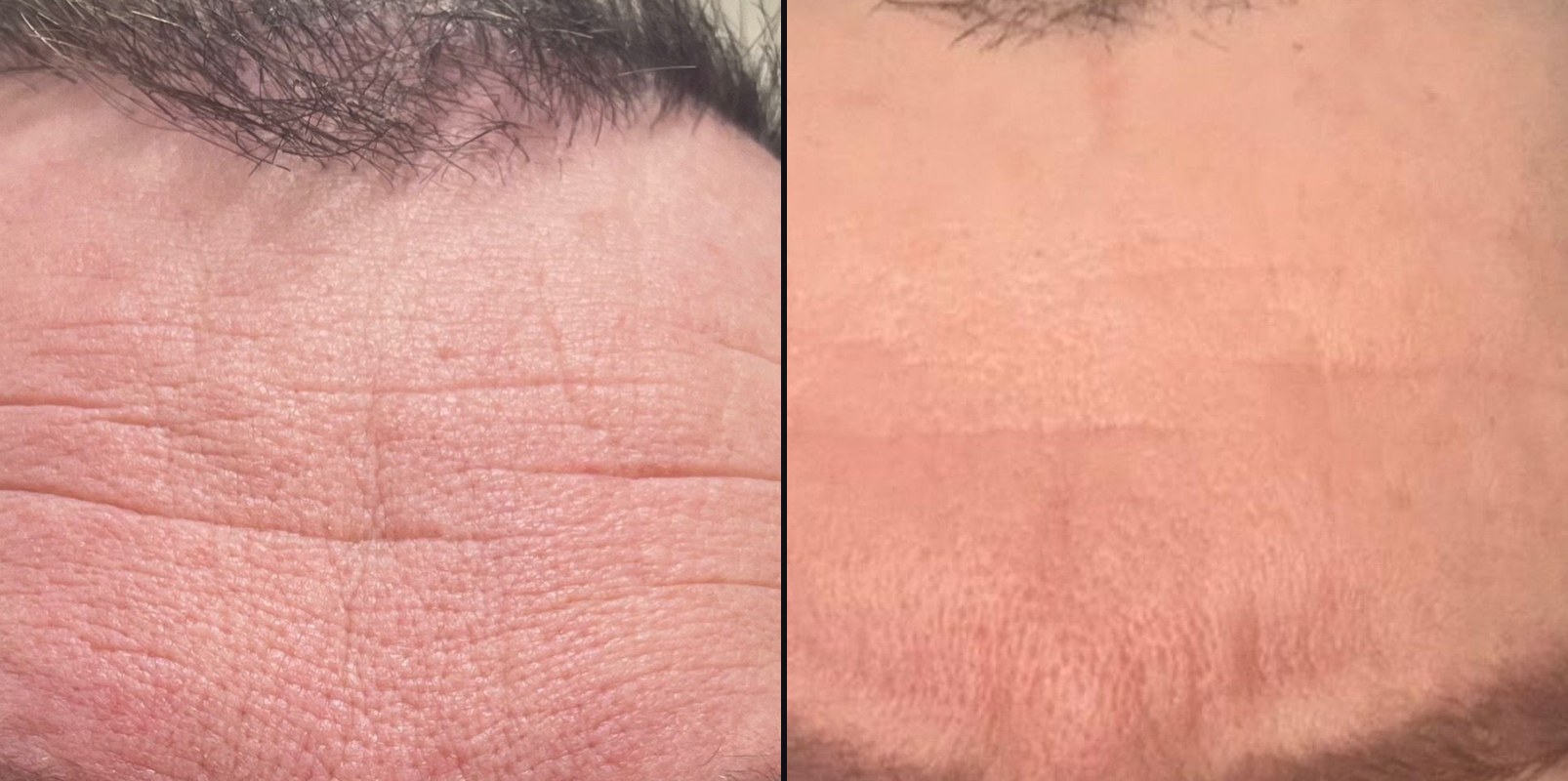 Before and after — Skin Lifting & Tightening
